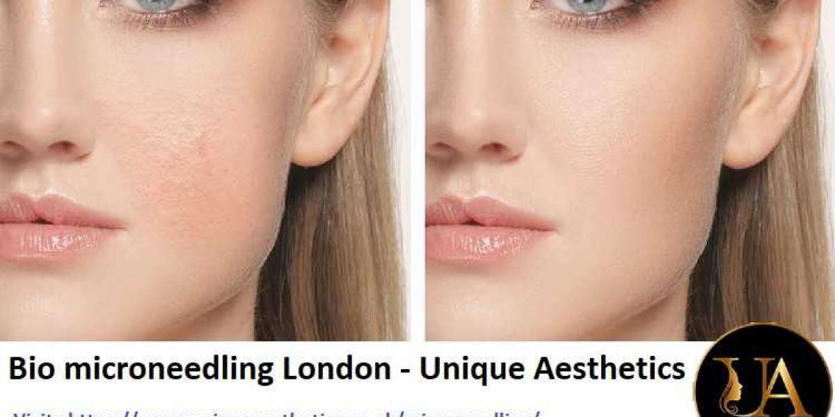 Microneedling London | Skin Rejuvenation for You