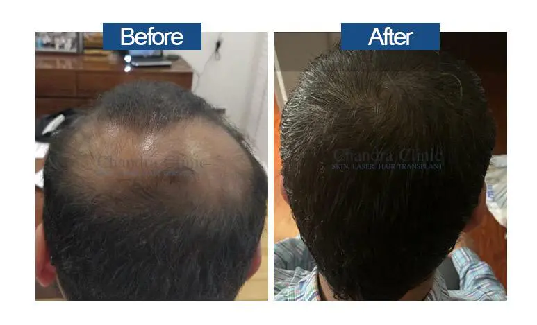 Hair Transplant in Delhi | Best Hair Transplant Clinic in Delhi