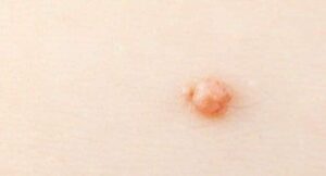 Genital Wart Removal Treatment London | Seborrheic Keratosis Removal | Dermatologist London